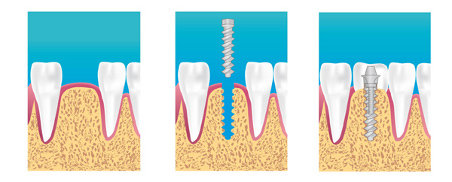 Le Docteur Shirley Cohen-Mahoun, dentiste à Issy-les-Moulineaux (92130), implants Implant dentiste à Issy-les-Moulineaux (92130)